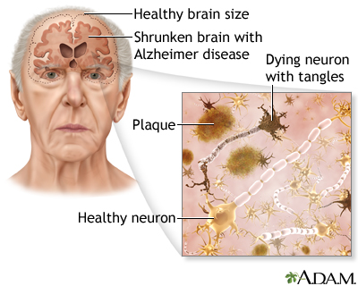 Alzheimer’s Disease- All You Need To Know